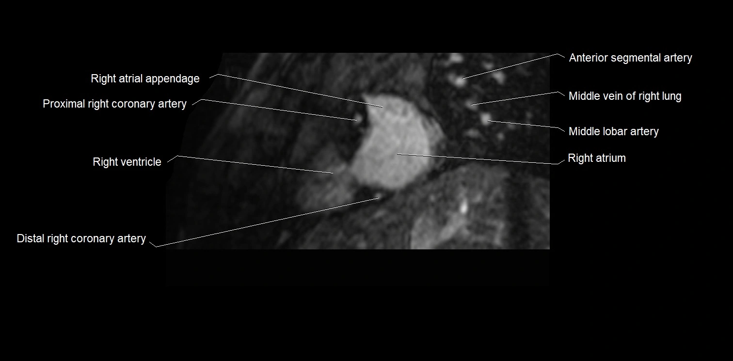 MRI heart and coronary arteries two chamber(sagittal)  anatomy image 6.webp